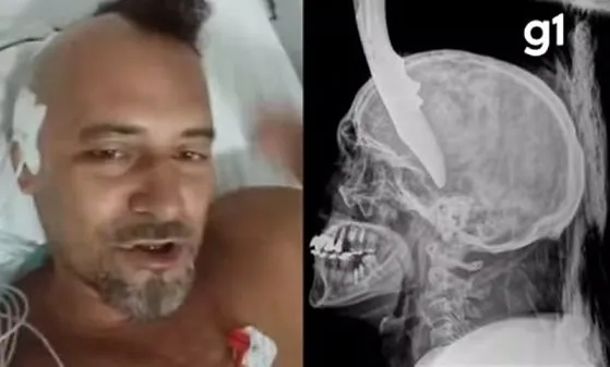 Eletricista tem canivete cravado na cabeça em briga com cunhado em MT